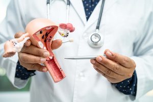 Lekarz trzymający model anatomiczny macicy pokazujący Usunięcie Polipa Szyjki Macicy