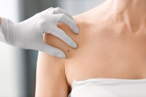 Lekarz pokazujący barwnikową zmianę skórną
