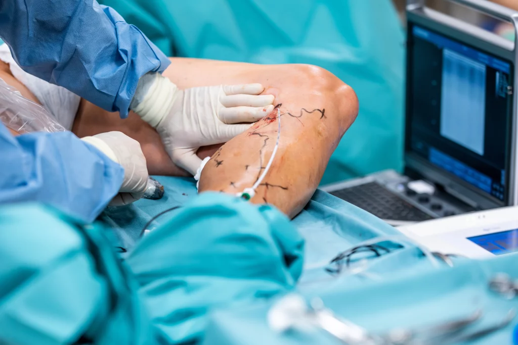 Laserowe Leczenie Żylaków Kończyn Dolnych Chirurgia Naczyniowa CM Sudety