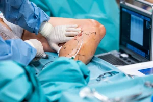 Laserowe Leczenie Żylaków Kończyn Dolnych Chirurgia Naczyniowa CM Sudety