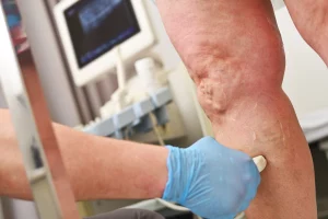Diagnostyka USG Doppler Chirurg Naczyniowy Leczenie Żylaków Wałbrzych CM Sudety