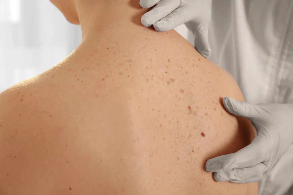 Badanie różnych znamion skórnych u dermataologa. Dermatoskopia Wałbrzych